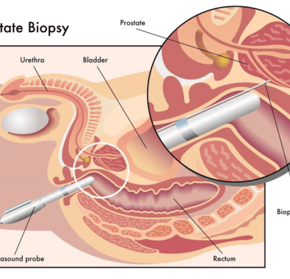 karkinos-prostath-yperhxos