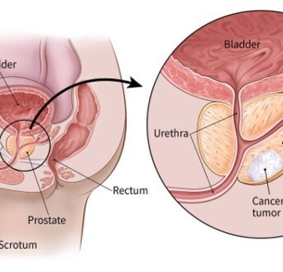 prostate-cancer